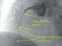 before-implantation