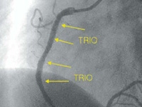 trio-after-implantation