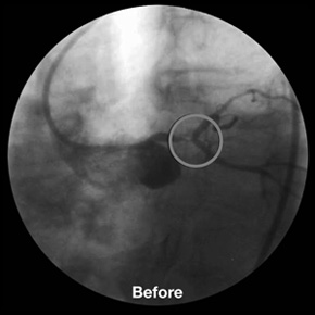 y-stenting_before